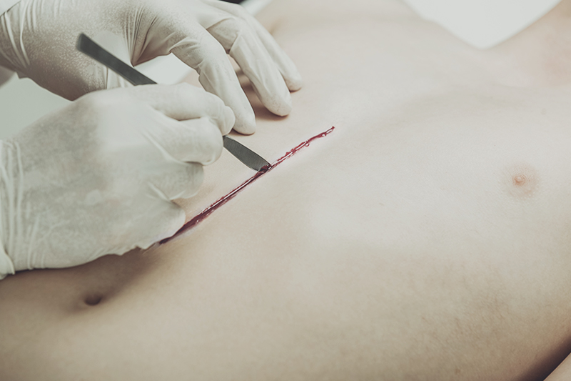 Surgical Glue That Can Seal Wounds in One Minute
