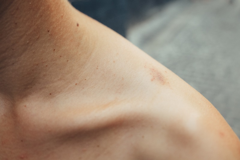 An Itchy Rash on the Neck