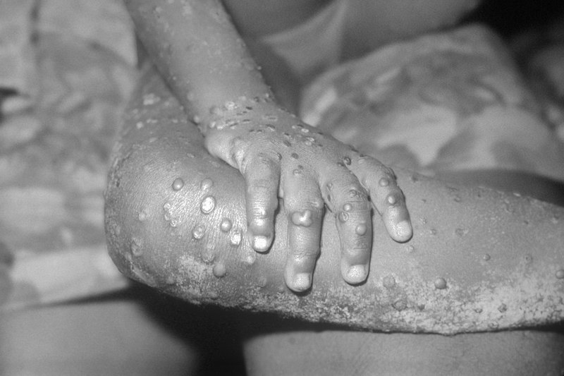 Monkeypox: A Warning Sign for the Future?