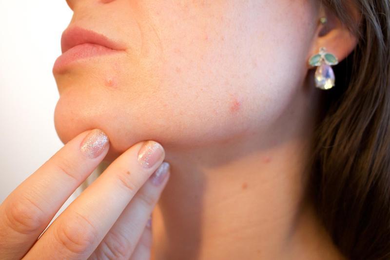 A Pimple on My Cheek