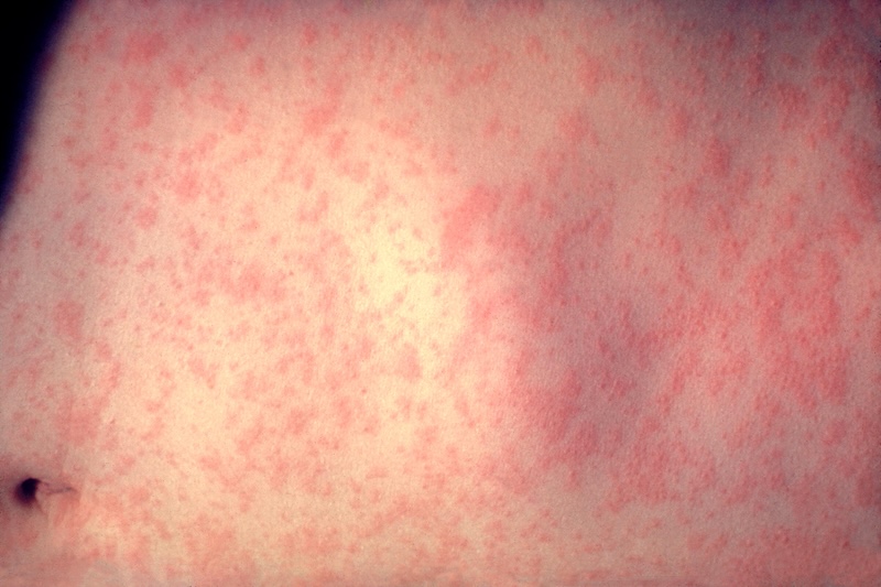 Number of Measles Cases Sparks Public Health Concerns in Taiwan